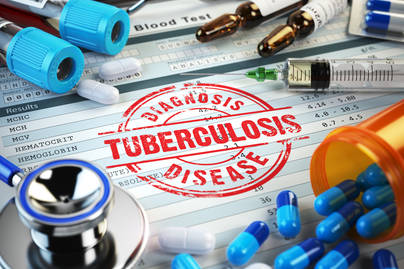 Tiap 6 Menit, 11 Orang Indonesia Meninggal Akibat Tuberkolosis