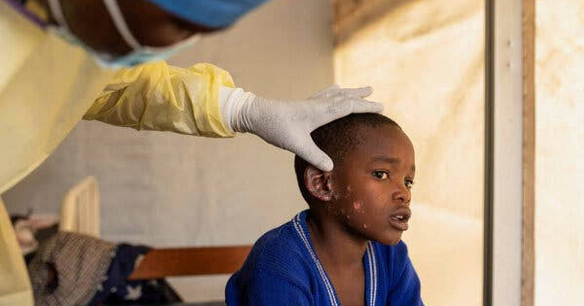 Jumlah Kasus Cacar Monyet di Uni Afrika Tembus Lebih dari 17 Ribu di 2024